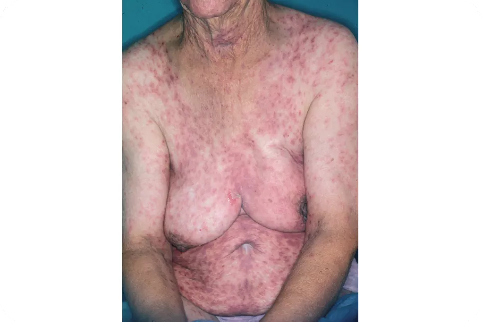 urticaria811