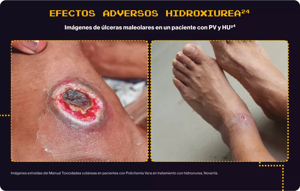 efectos adversos hidroxiurea