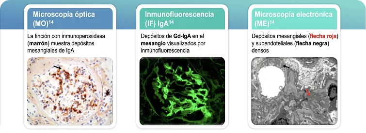 Biopsia de riñón en Nefropatía IgA