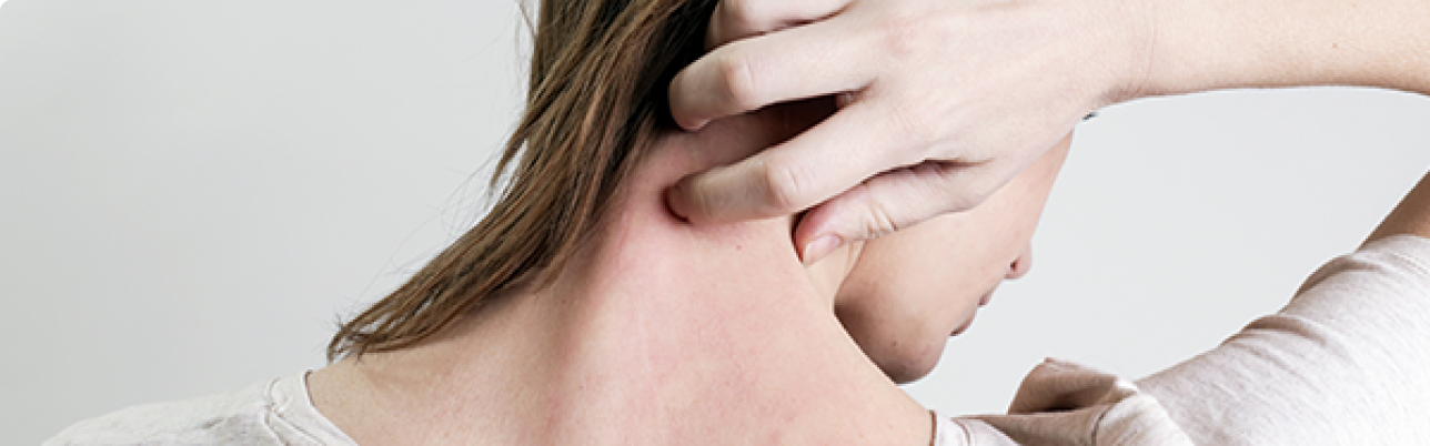 Urticaire chronique spontanée