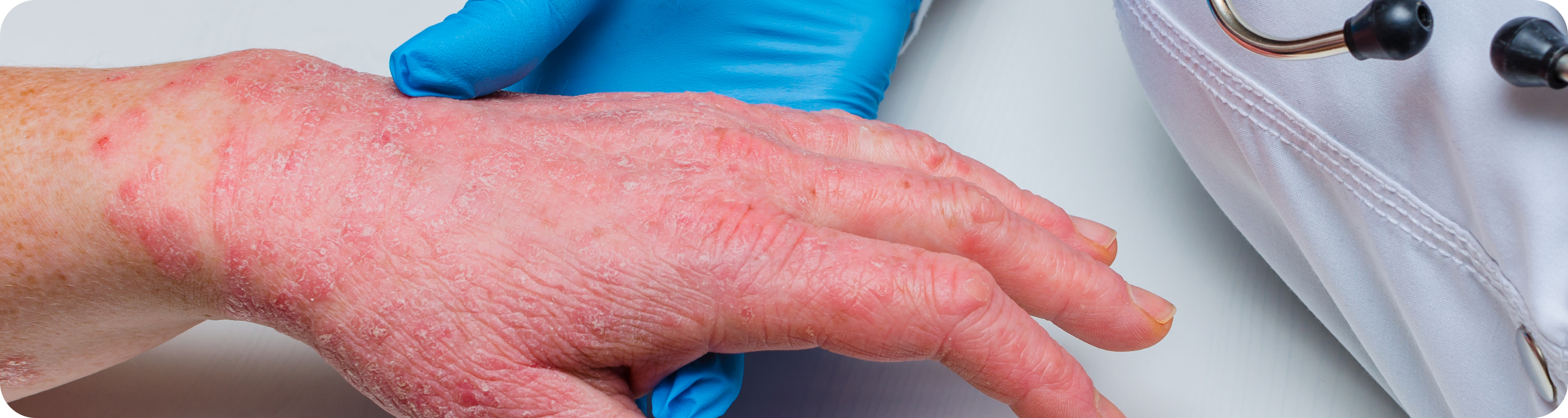 Psoriasis et zones difficiles à traiter - Quel impact en vie réelle ? Psoriasis et zones difficiles à traiter - Quel impact en vie réelle ?