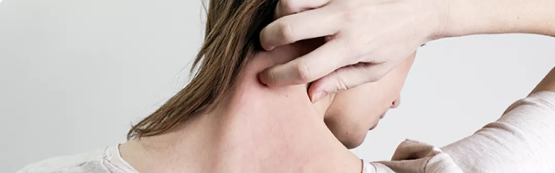 Urticaire chronique spontanée