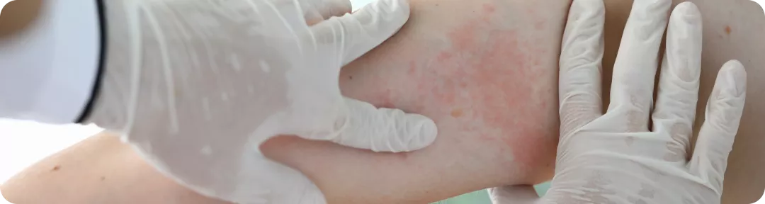 Les thérapies biologiques pourraient-elles modifier l’évolution de la maladie psoriasique ?