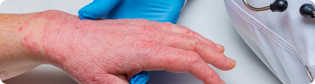 Psoriasis et zones difficiles à traiter - Quel impact en vie réelle ?