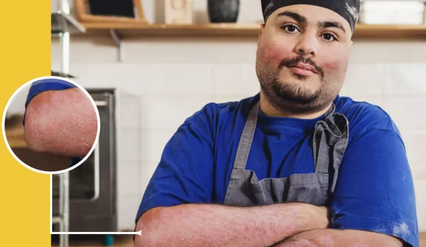 Le psoriasis ne se limite pas à ma peau Le psoriasis ne se limite pas à ma peau