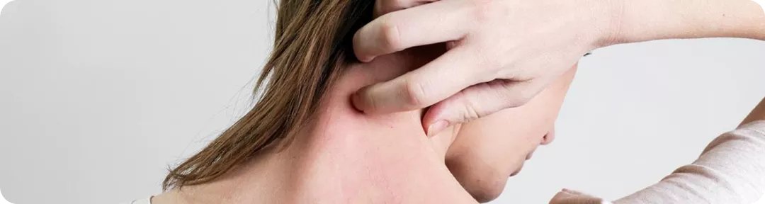 Urticaire chronique spontanée