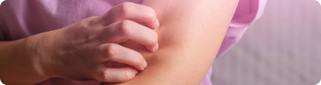 L’urticaire chronique - Revue de la littérature