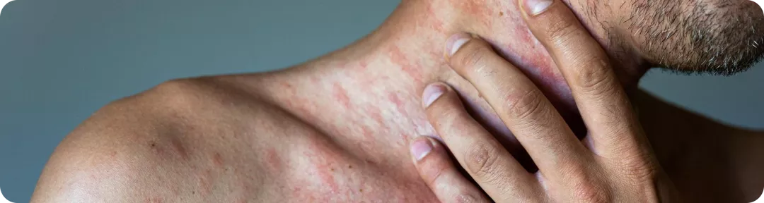 Prise en charge de l'urticaire