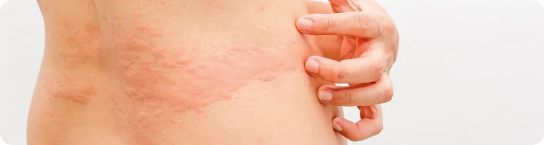 Repères pour un bilan complet de l'urticaire chronique spontanée (UCS)