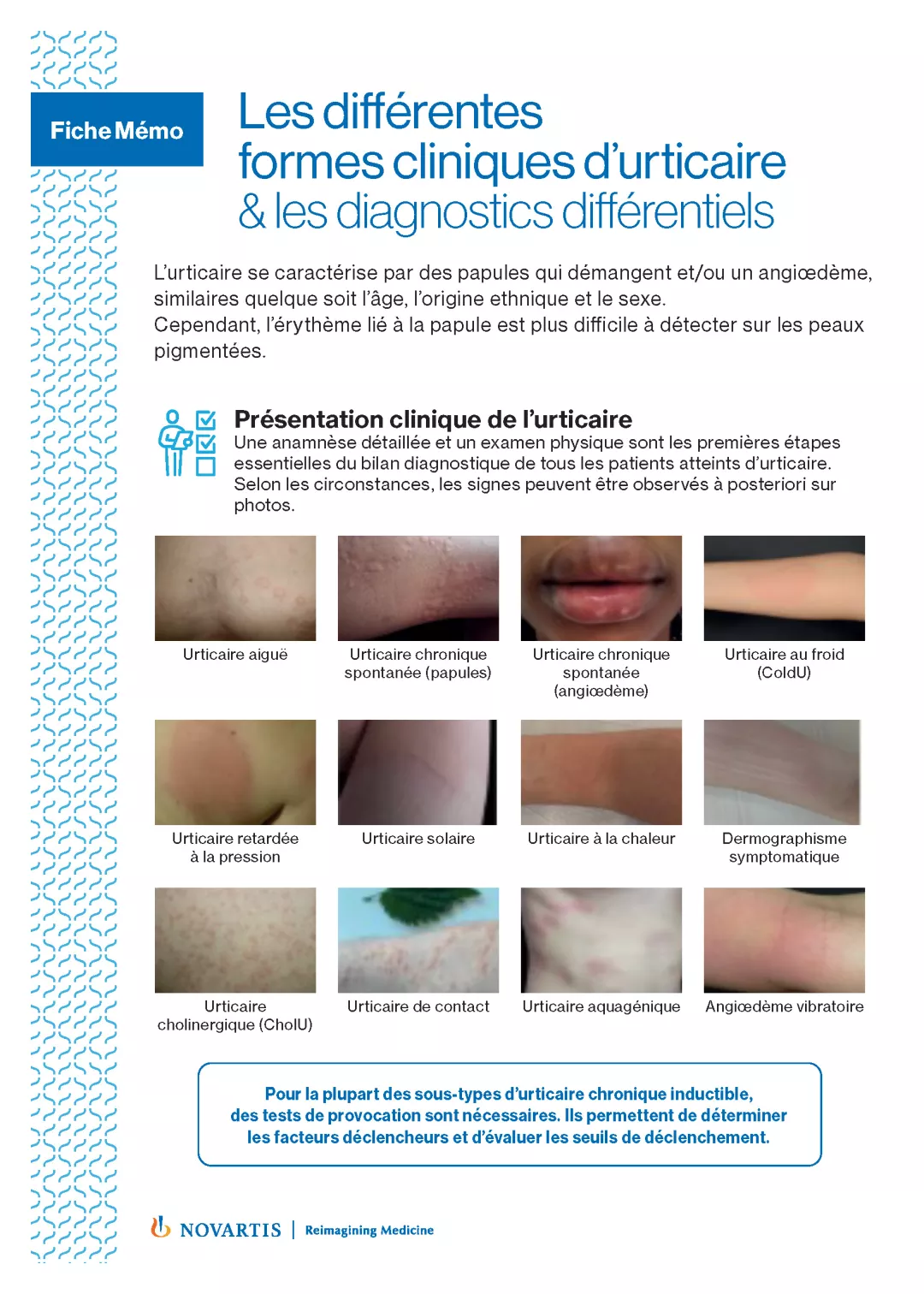 Les différentes formes cliniques d’urticaire 