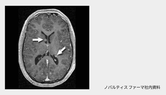 脳病変（SEGA、大脳皮質結節、SEN等）｜結節性硬化症に伴う症状