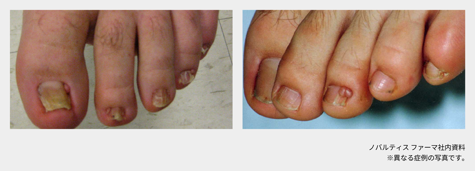 afinitor_tsc_symptom_06_04_pc.png afinitor_tsc_symptom_06_04_pc.png