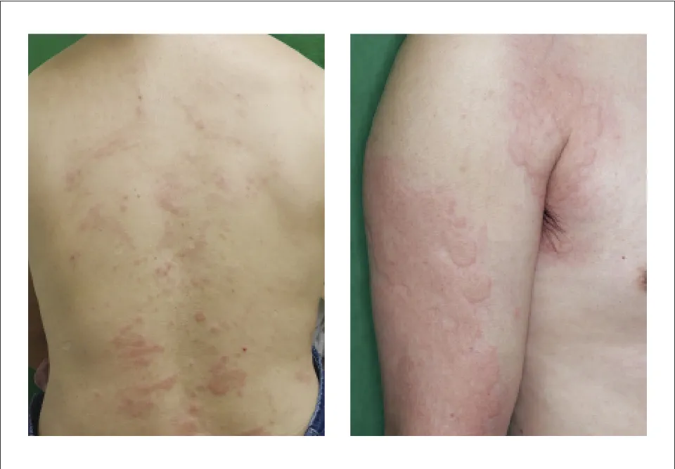 図1. 慢性特発性蕁麻疹 40歳男性 写真（葉山先生ご提供）