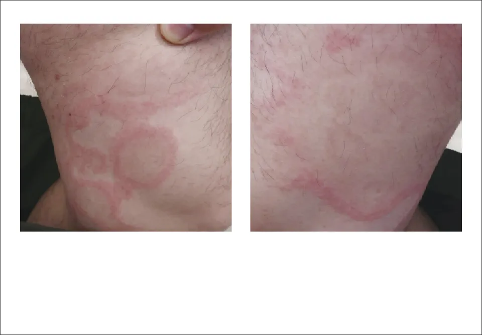 図2. 慢性特発性蕁麻疹 40歳男性 写真（高橋先生ご提供）