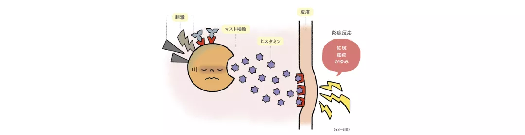 じんましんはなぜ起こるの？発症のイメージ図