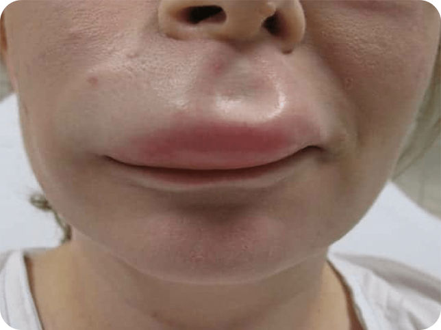 Angioedema-1 Angioedema-1