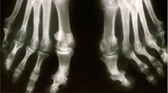 Artritis psoriatica Artritis psoriatica