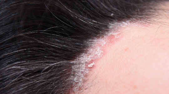 Psoriasis capitis Psoriasis capitis