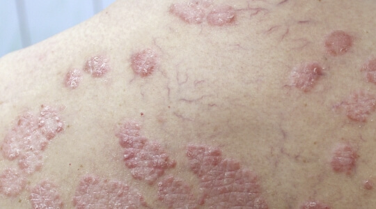 Psoriasis erytrodermie Psoriasis erytrodermie