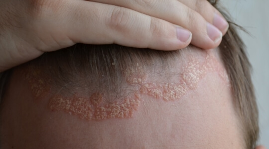Psoriasis guttata Psoriasis guttata