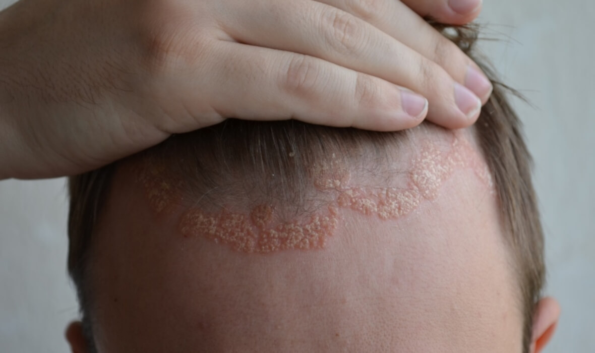 Herken psoriasis direct Herken psoriasis direct