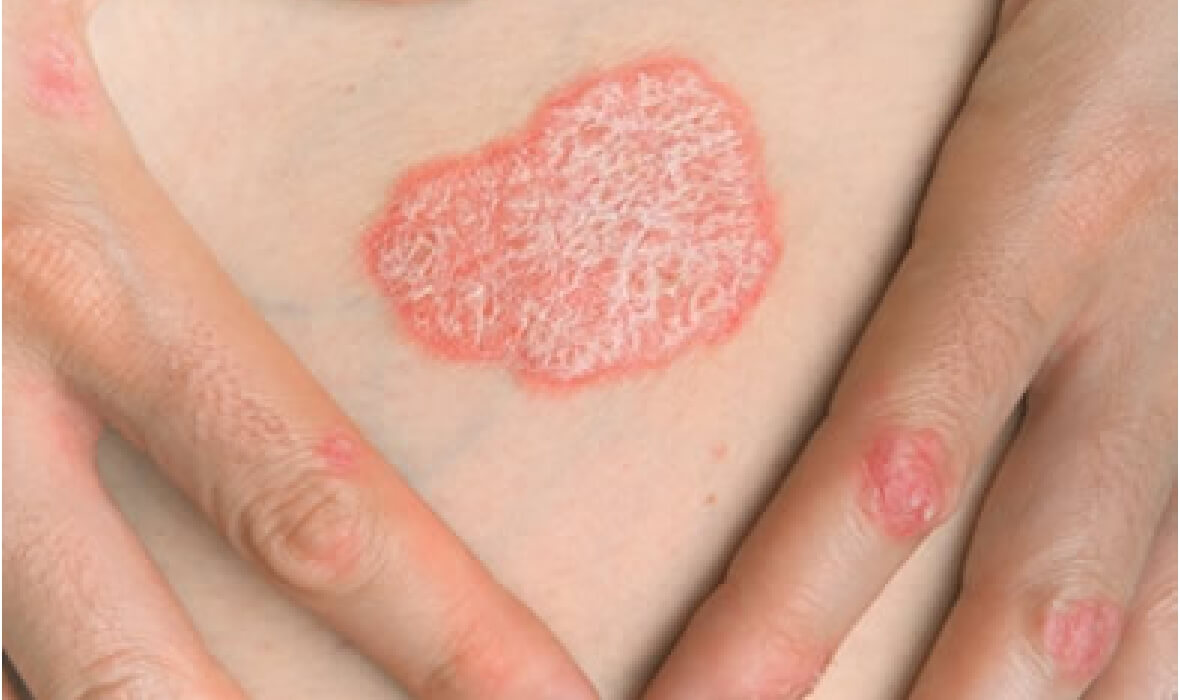 Immunologische aspecten van psoriasis Immunologische aspecten van psoriasis