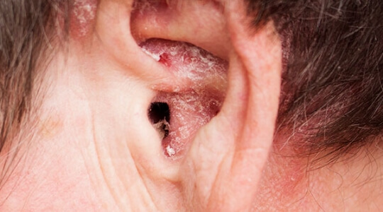 Psoriasis inversa Psoriasis inversa