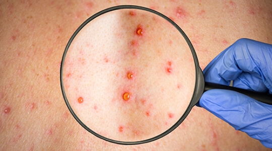 Psoriasis pustulosa Psoriasis pustulosa