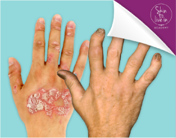 Masterclass Psoriatic Disease Masterclass Psoriatic Disease