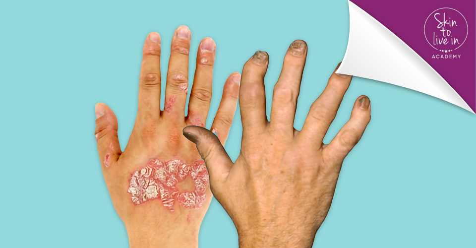 Masterclass Psoriatic Disease Masterclass Psoriatic Disease