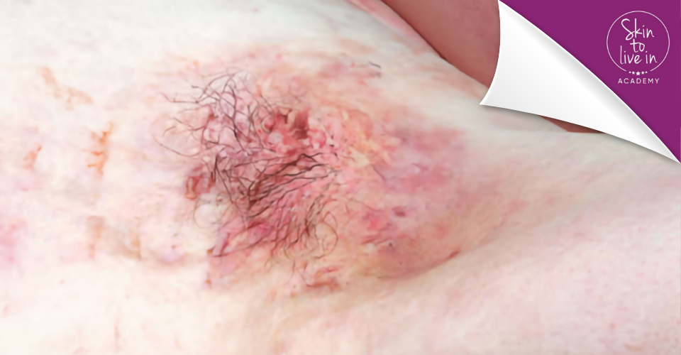 Masterclass Hidradenitis Suppurativa Masterclass Hidradenitis Suppurativa