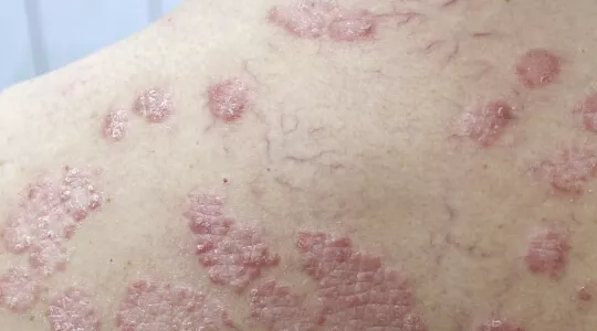 Psoriasis erytrodermie