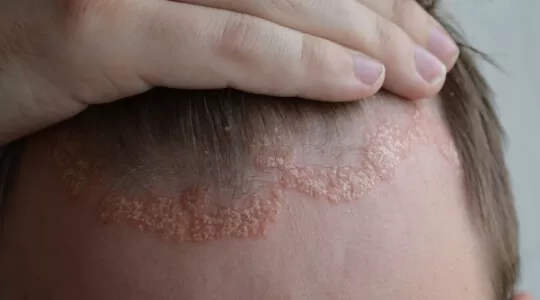 Psoriasis guttata
