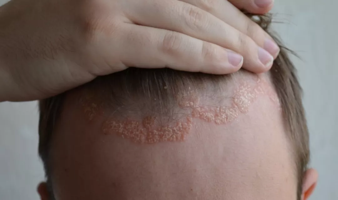 Herken psoriasis direct