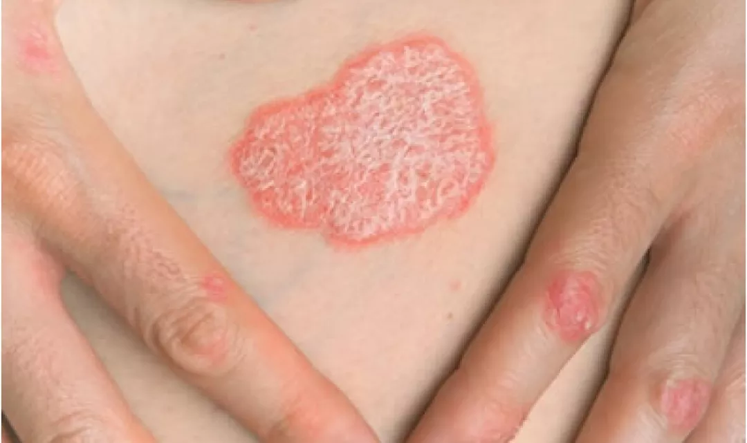 Immunologische aspecten van psoriasis