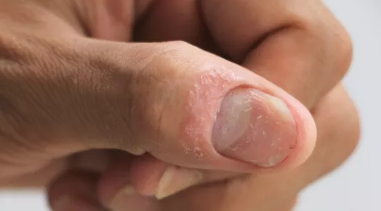 psoriasis unguium