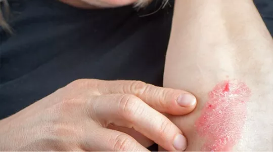 psoriasis vulgaris