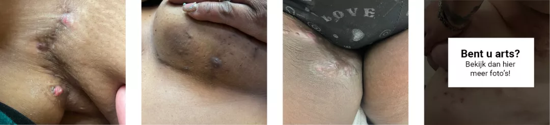 Hidradenitis foto's