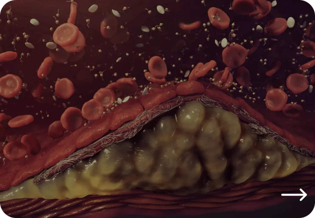 Lp(a) te hoog, wat nu Novartis Cardiologie lipoproteine(a) 2