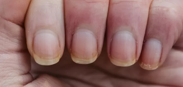 psoriasis_klinische-subtypen