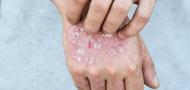 psoriasis_pathogenese