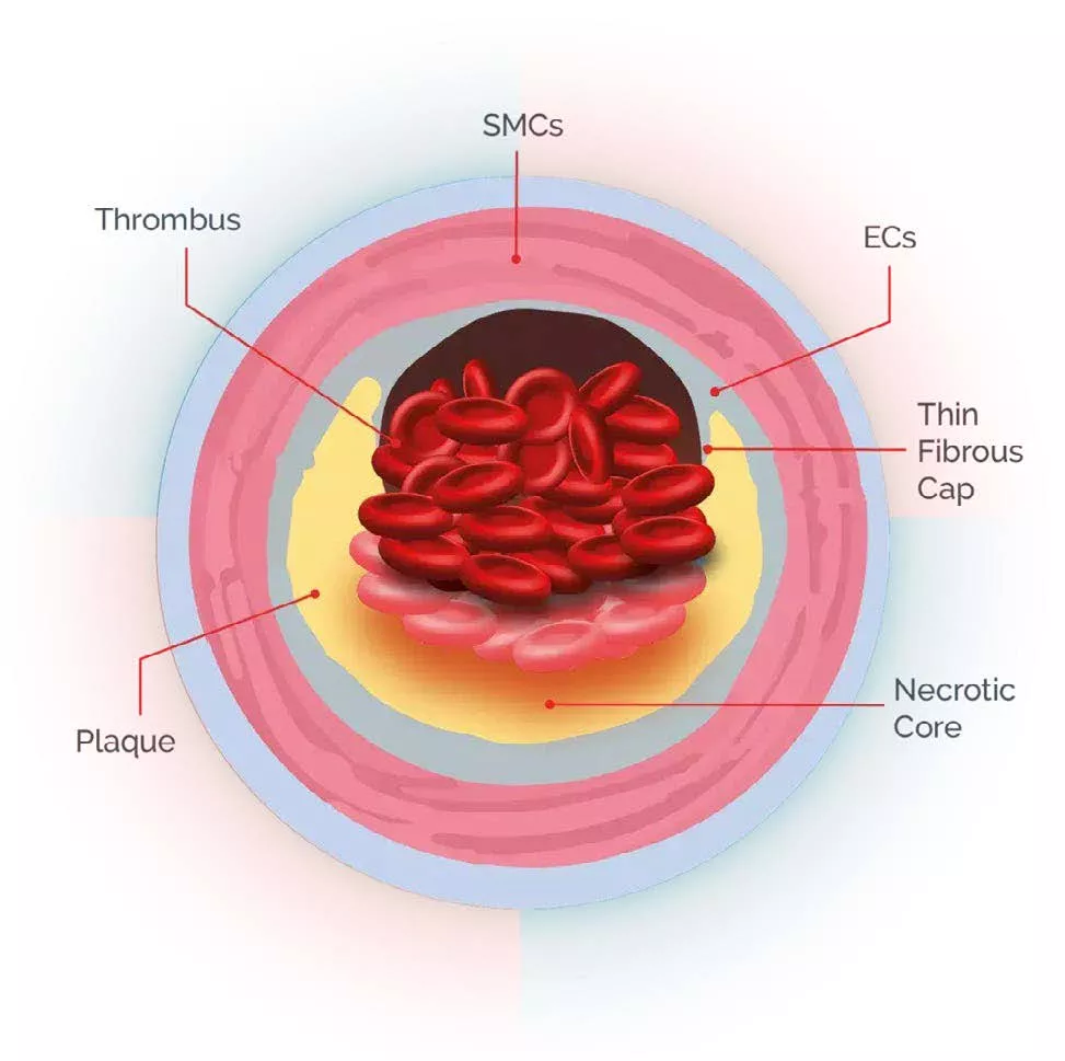 novartis_lp-a_onepager4_digitala4_250430_korr.jpeg novartis_lp-a_onepager4_digitala4_250430_korr.jpeg