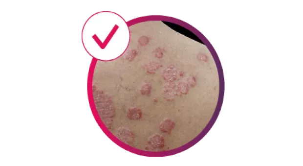 cosentyx-derm-Image_showing_PsO_with_the_text_55