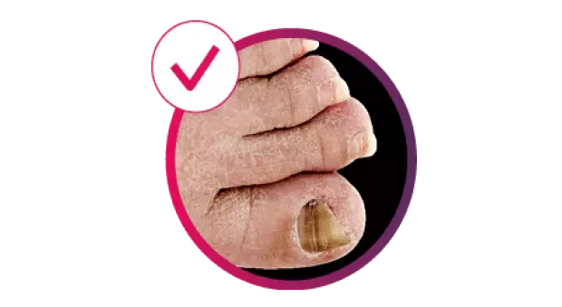 cosentyx-derm-Image_showing_nail_PsO_with_the_text_'73%'