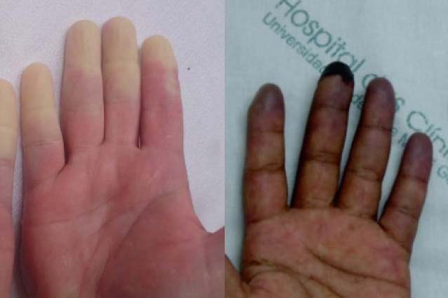 Бледность пальцев рук и ног