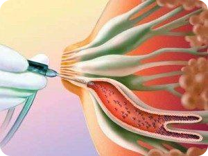 Дуктография