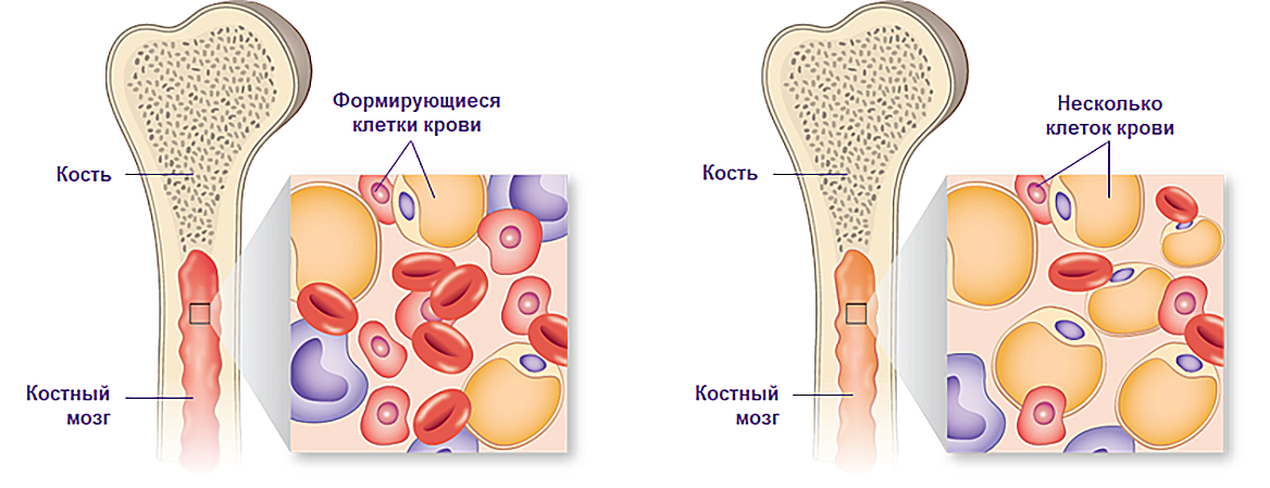 Здоровый (слева) и апластический костный мозг (справа) Здоровый (слева) и апластический костный мозг (справа)