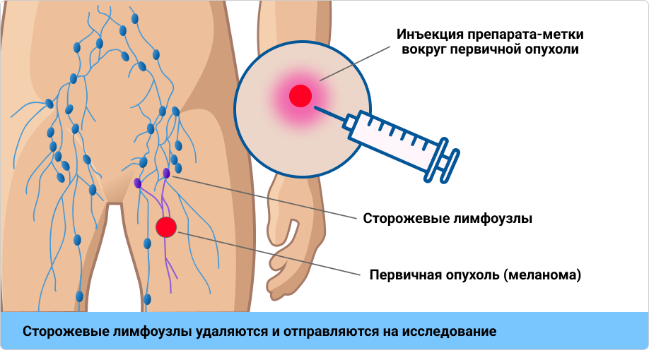 Методика проведения БСЛУ. Методика проведения БСЛУ.