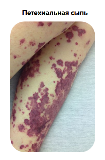 Петехиальная сыпь