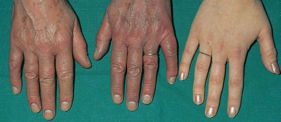 Плетора кистей рук